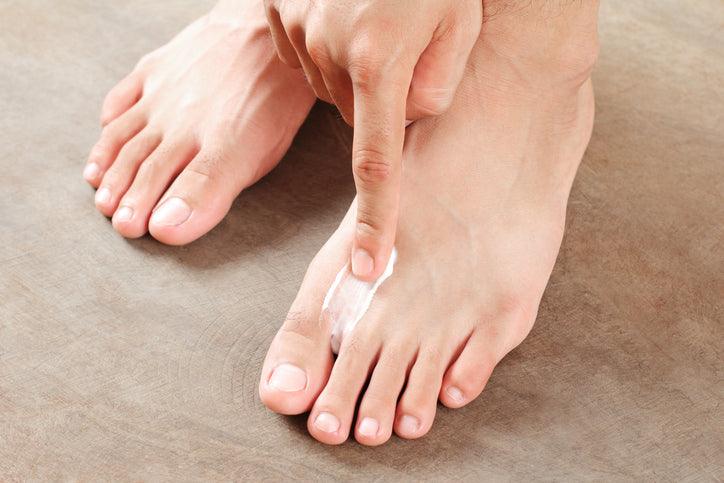 Athlete's Foot: What It Looks Like, Symptoms & Treatment - fayybek