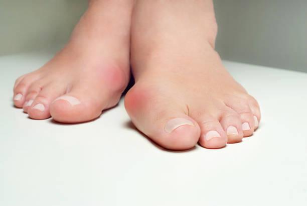 Bunions: Causes, Symptoms, and Treatment. - fayybek
