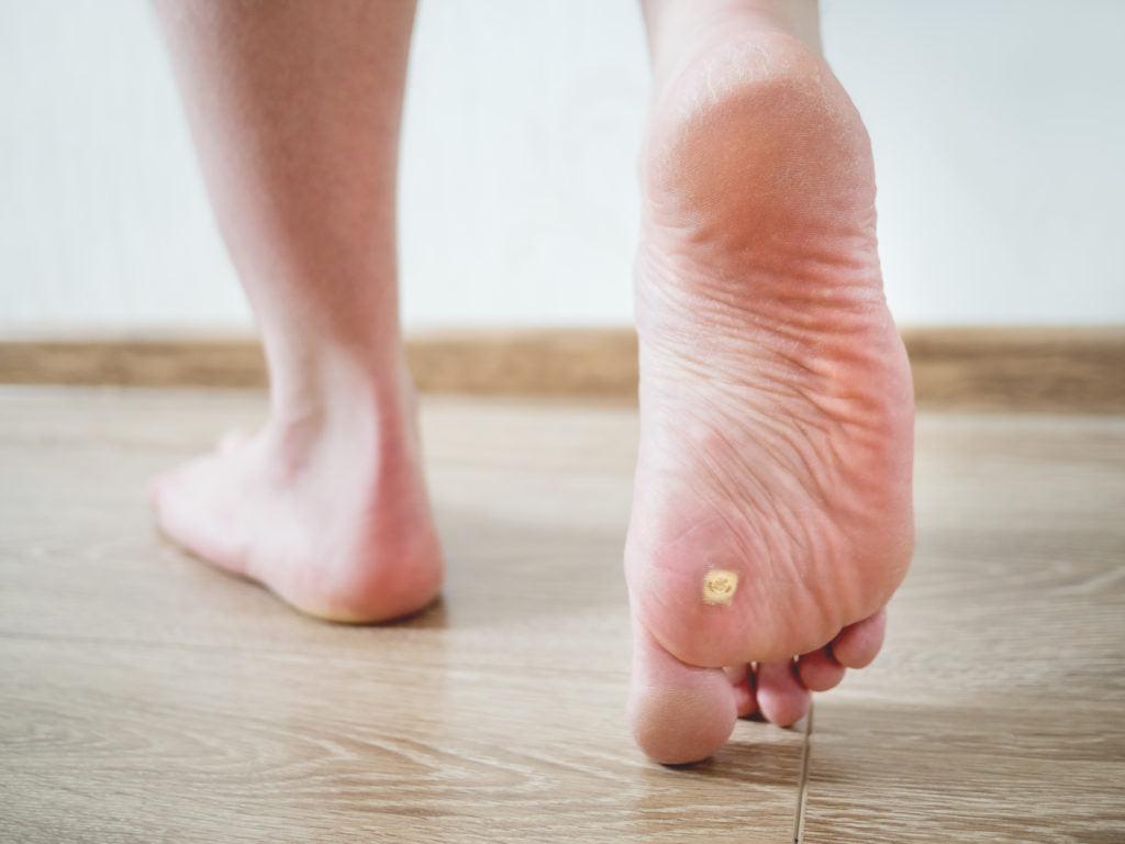 Plantar Wart: What is it, Symptoms, and  Treatment. - fayybek